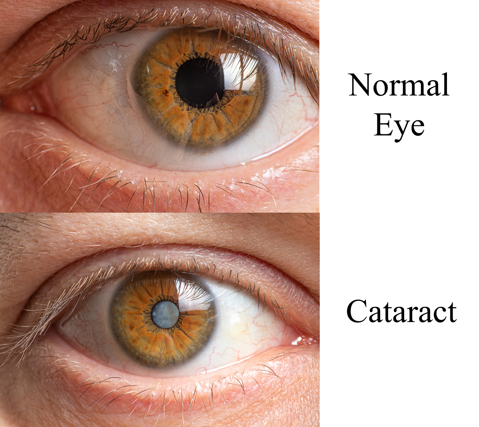 Comparison of a healthy human eye and an eye with a clouded lens cataract.