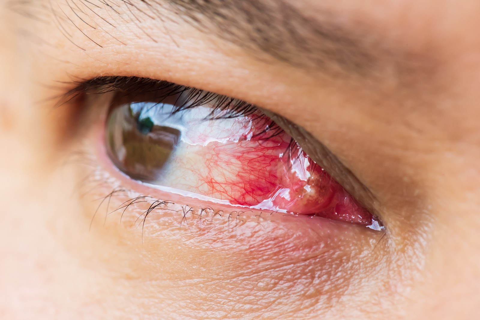 pterygium-eye-condition-and-removal