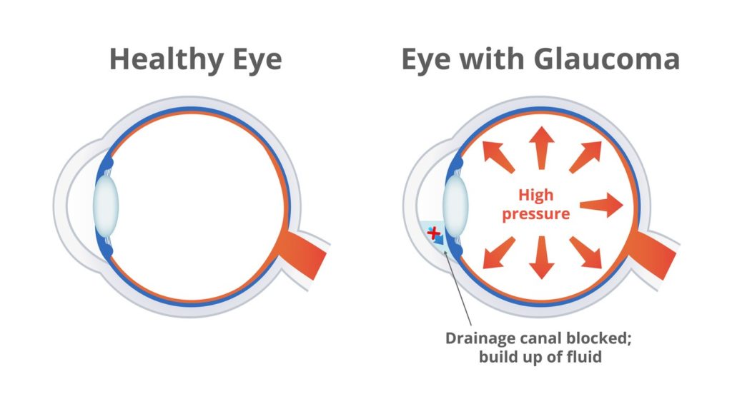 glaucpoma-infographic